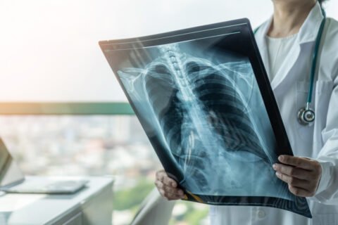 Doctor diagnosing patientâs health on asthma, lung disease, COVID-19 or bone cancer illness with radiological chest x-ray film for medical healthcare hospital service